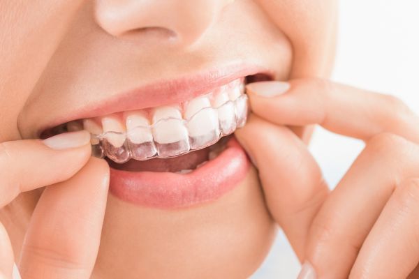 Teeth Straightening Kits